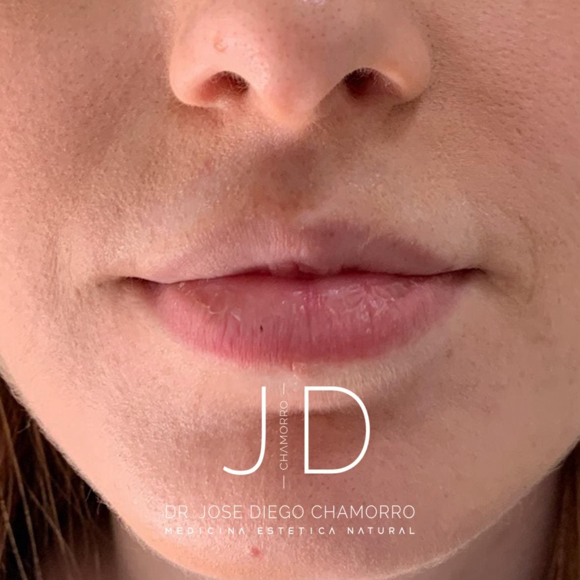 antes-labios1 antes-labios1