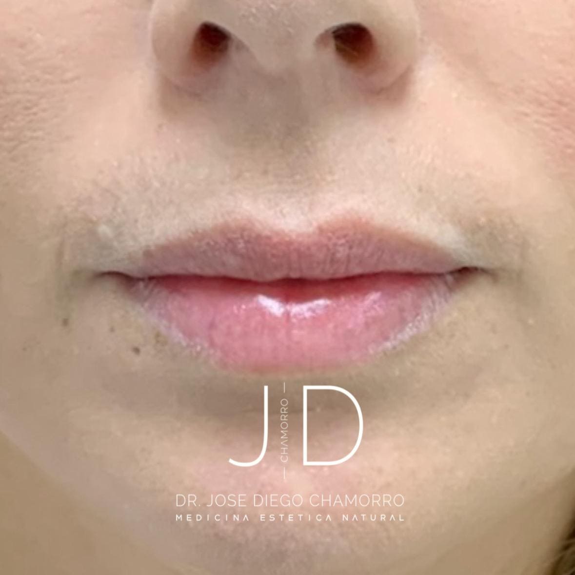 antes-labios2 antes-labios2