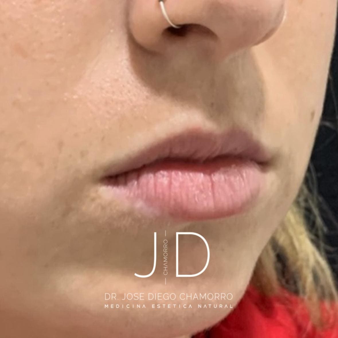 antes-labios4 antes-labios4